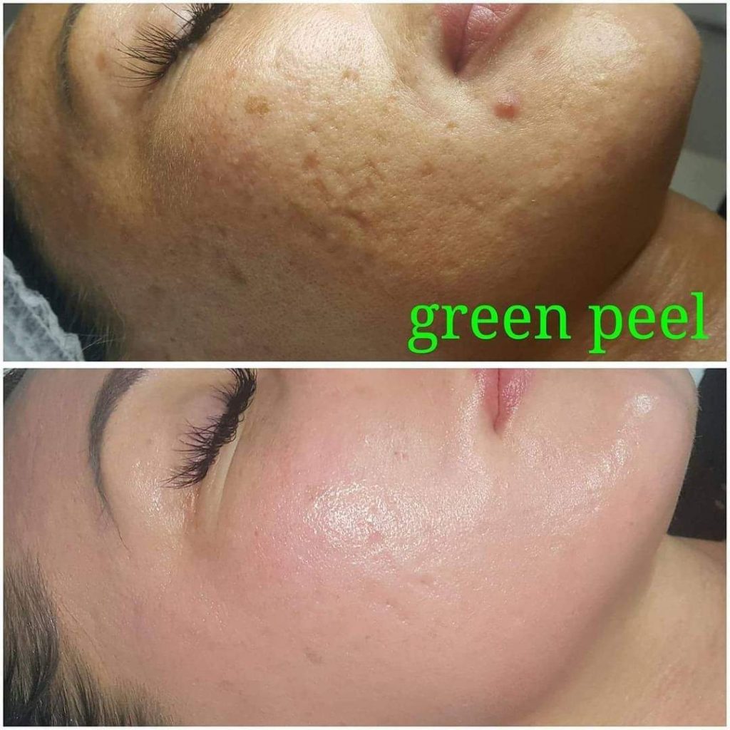 Dr.med. Christine SCHRAMMEK GREEN PEEL